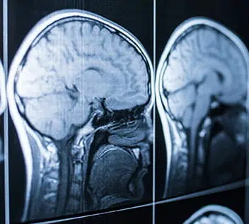 common brain injury symptoms missed after car crash